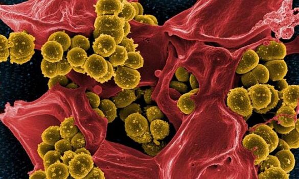 Staphylococcus aureus als Ursaach vu bakterieller Prostatitis