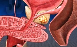 A rák jelei a prosztatitisben Milyen betegség a prostatitis