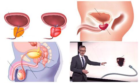 gesond a krank Prostata